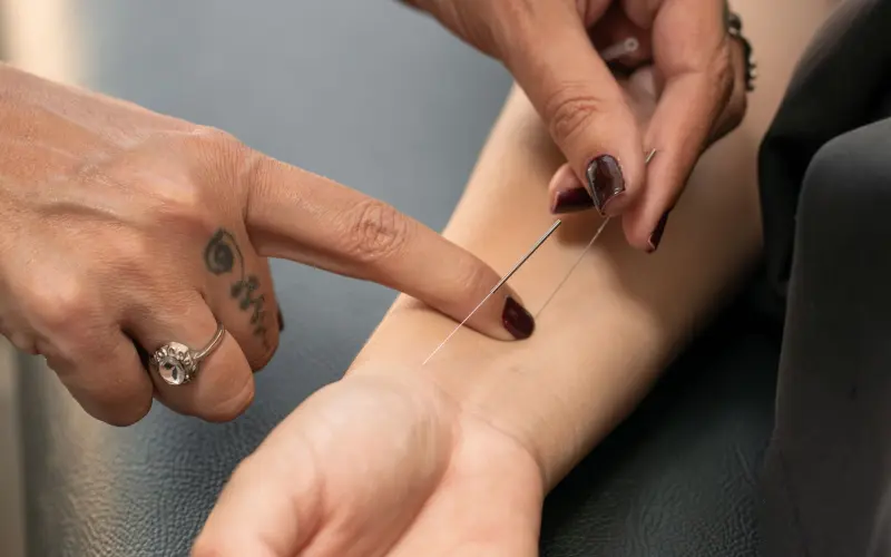Profissional insere agulhas de acupuntura no antebraço de paciente em maca