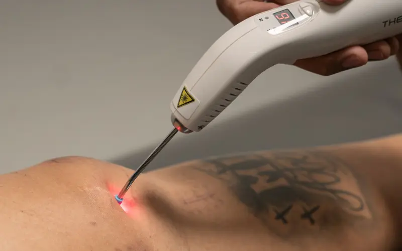 Fisioterapeuta aplica laserterapia no joelho com equipamento portátil de luz vermelha