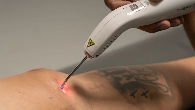 Fisioterapeuta aplica laserterapia no joelho com equipamento portátil de luz vermelha
